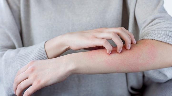 Pikkelysömör (pszoriázis, psoriasis) tünetei és kezelése - HáziPatika