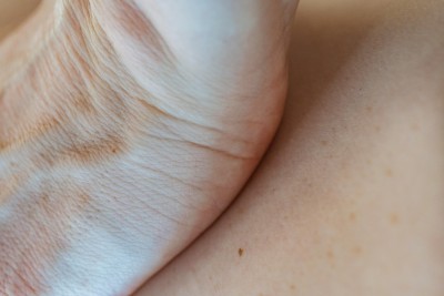 A nap árnyékos oldala - A basalioma megelőzése és kezelése
