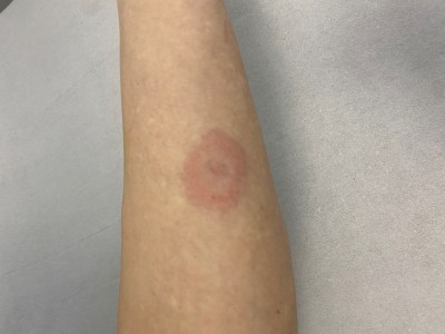 Így leplezhetjük le gyorsan a Lyme-kórt: tudjon meg mindent a megelőzéstől a betegség lefolyásáig