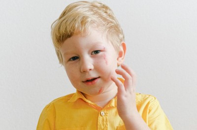 Így ismerheti fel és kezelheti könnyen az ótvart - képekkel