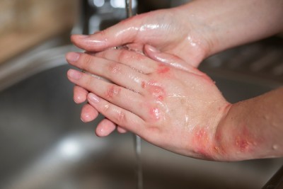 Seborrheás dermatitis: okok, tünetek és modern kezelések