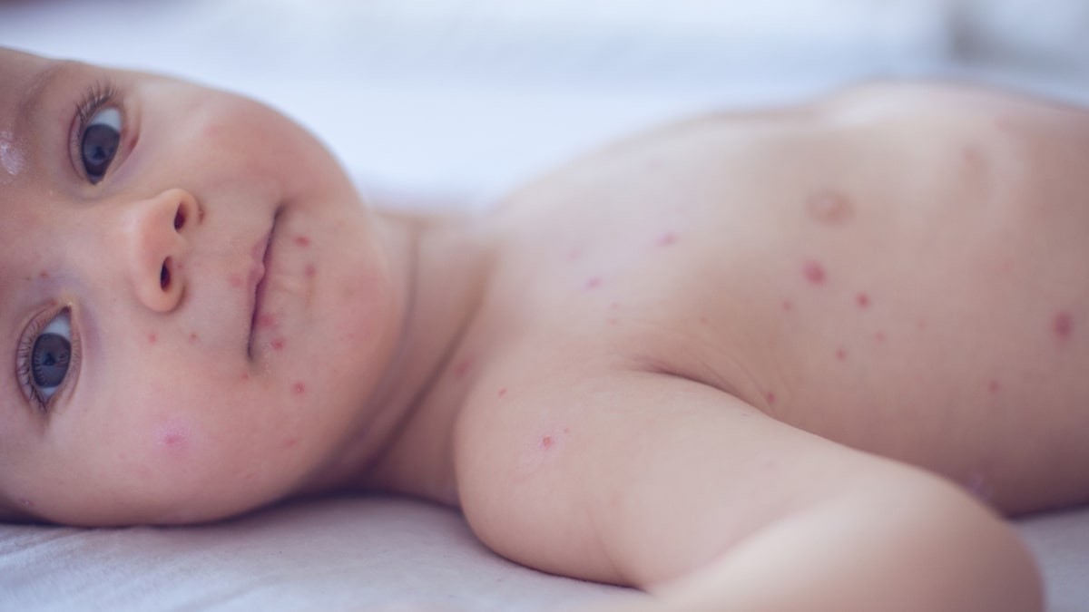 Koronavírus: ezektől függ, hogy a gyerekek enyhe vagy súlyos tünetekkel esnek át a fertőzésen